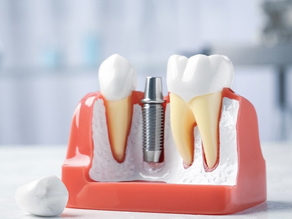 A mouth mold containing a dental implant 