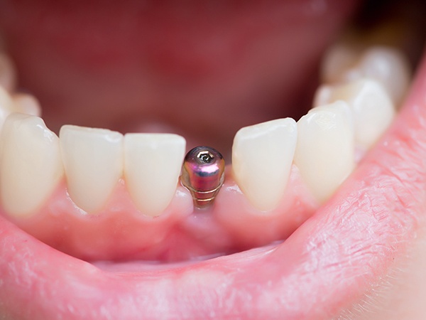 patient smiling with abutment in mouth