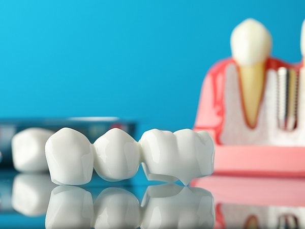 A dental bridge and implant parts set against a blue background