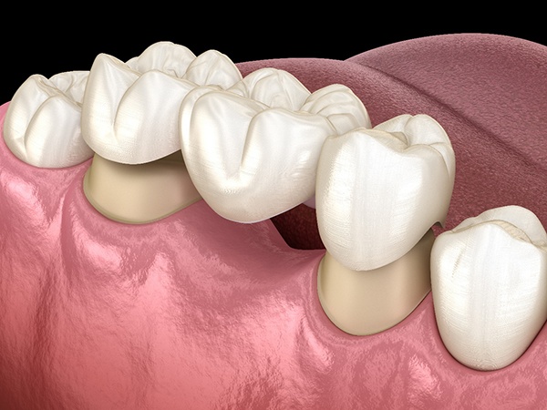 A 3D illustration of a dental bridge