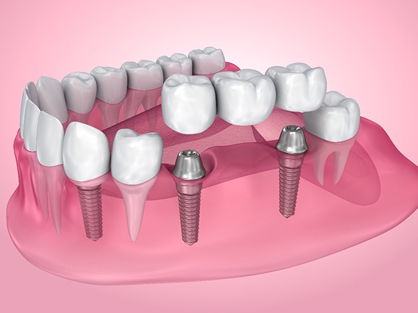 A 3D illustration of an implant bridge