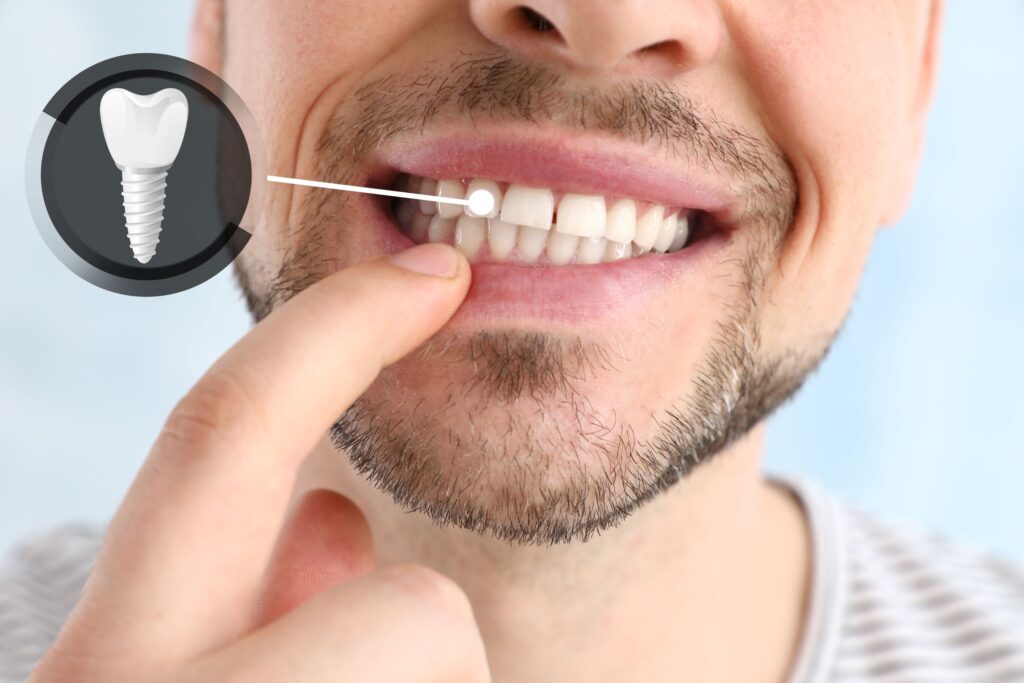 Nose-to-neck image of man pointing to his teeth with one indicated as implant