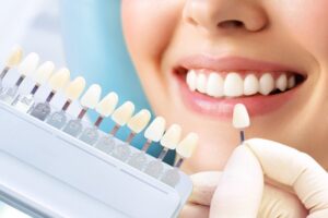 Dental veneers. 